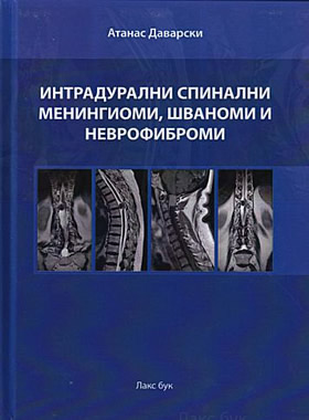 Интрадурални спинални менингиоми, шваноми и неврофиброми