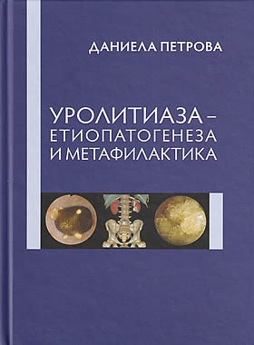 УРОЛИТИАЗА - етиопатогенеза и метафилактика